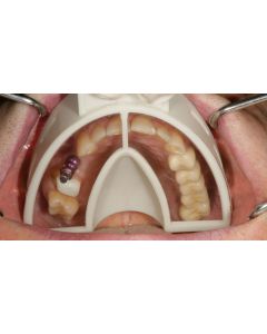 Hager+Werken Miratray Implant UK L3 large